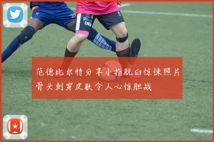 范德比尔特分享小指脱臼惊悚照片骨头刺穿皮肤令人心惊胆战